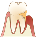 歯石がついている歯の断面図
