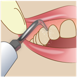 歯石を取っている口元のイラスト